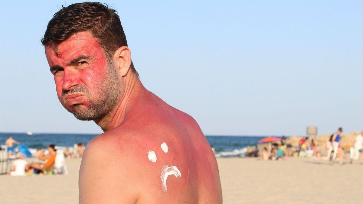 melanoma